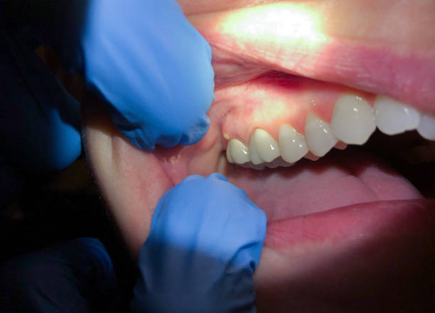 Best Emergency Gum Treatment in Bushnell, FL